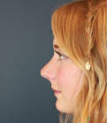 Feel Beautiful - Rhinoplasty California - After Photo